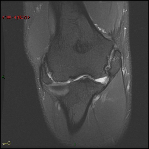 Figure 5 for case Ununited epicondylar fractures
